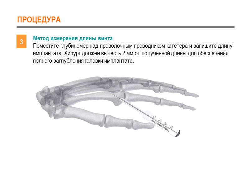 ПРОЦЕДУРА 3 Метод измерения длины винта Поместите глубиномер над проволочным проводником катетера и запишите